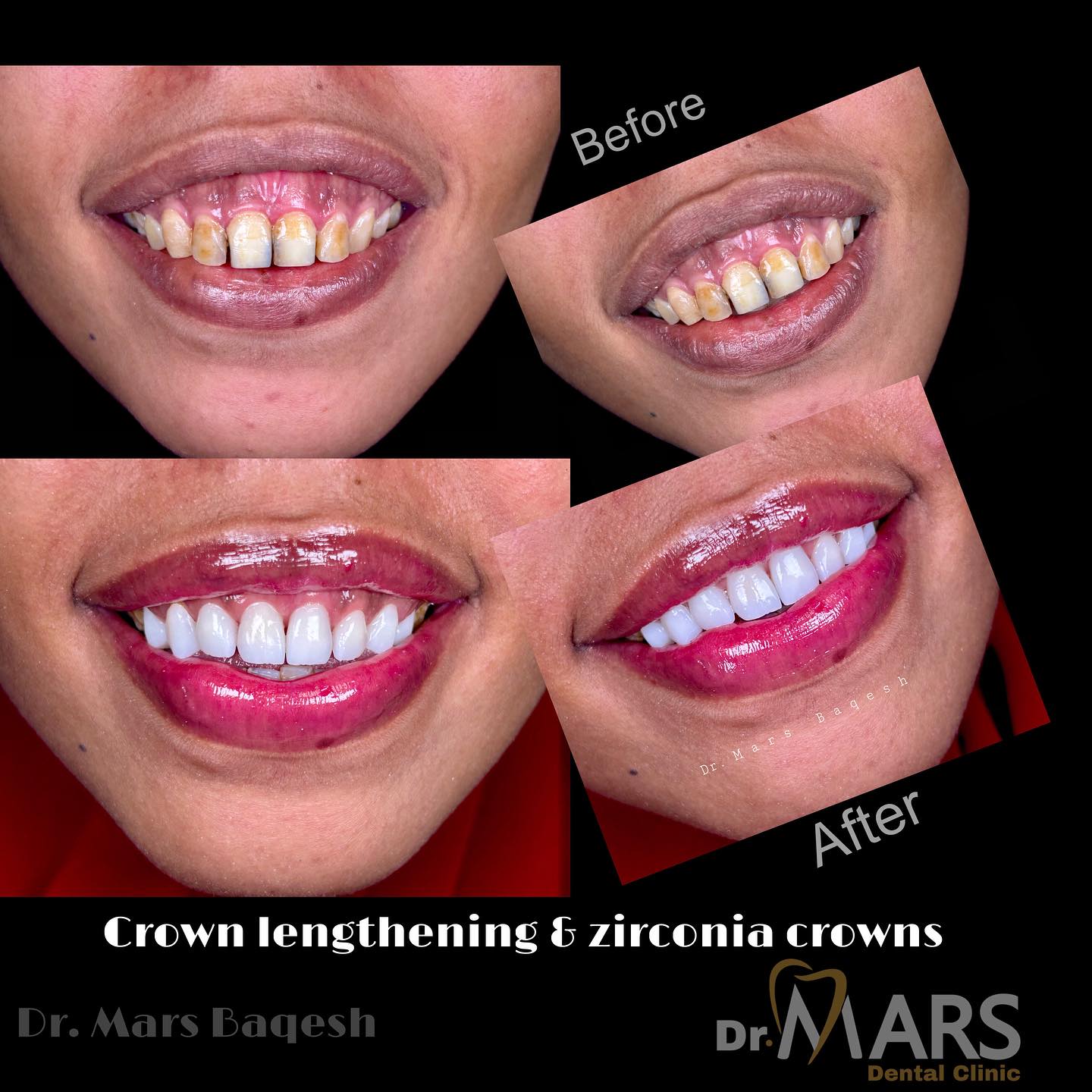 Full Mouth Rehabilitation